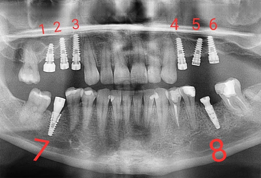 Exemplo de radiografia de boa qualidade